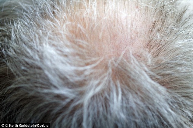 Thinning hair? Researchers said as cells in the scalp age, they accumulate errors in their DNA which causes them to take a different path. This means they mature into skin cells rather than replacement follicle cell