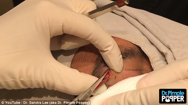 After removing the cyst, Dr Pimple Popper neatly stitches the area