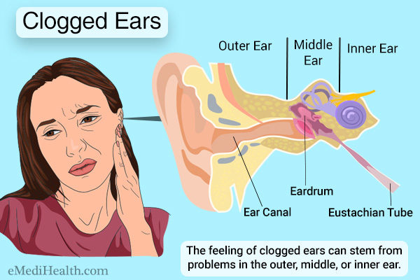 Clogged ears representation