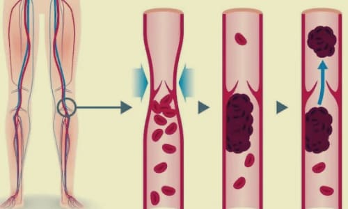 Сгустки крови, тромбоз