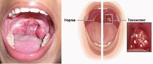 Увеличение миндалин 