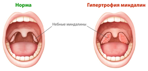 Миндалины увеличены