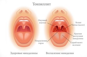 Хронический тонзиллит