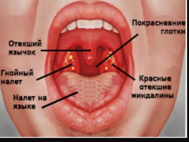 Что такое кандидозный транзилит