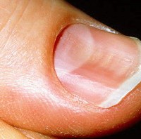 concave fingernail