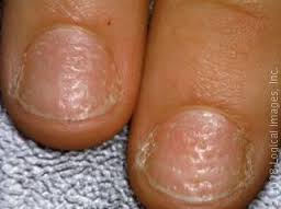 pitted fingernails