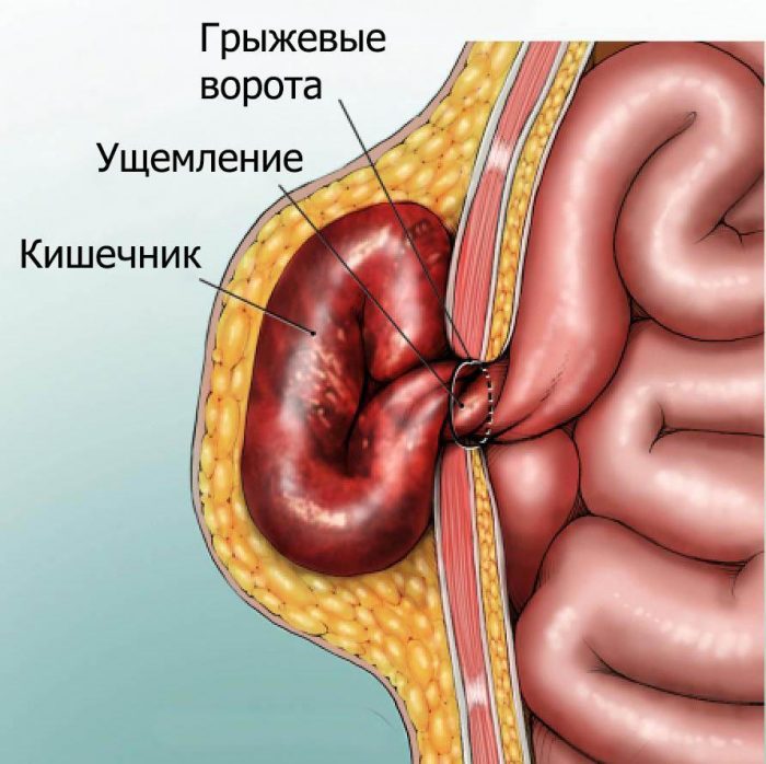 паховая грыжа