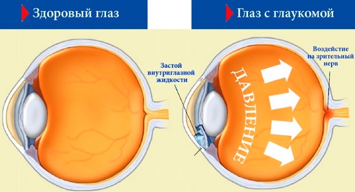 Развитие глаукомы человека