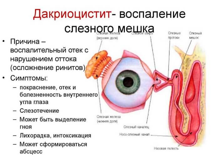 Дакриоцистит - воспаление мешочка