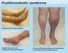 Post Thrombotic Syndrome