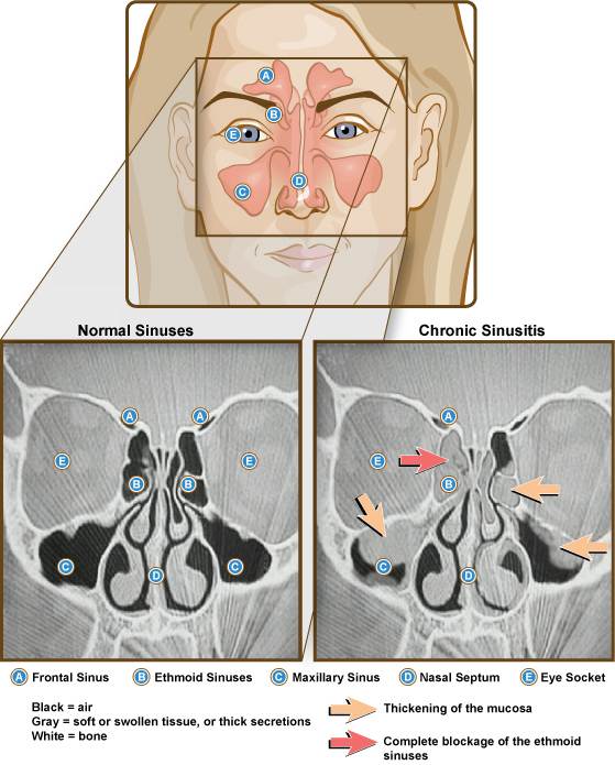 Sinuses and chronic sinusitis