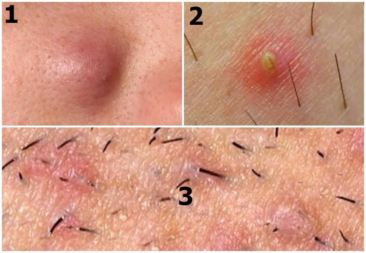 Underarm ingrown hair - different presentations: (1) Deep cyst or boil - (2) Pus filled pimple - (3) Folliculitis affecting large area