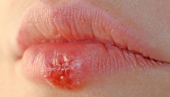 Гнойник, язвочка или болячка на губе? Советы, как быстро избавиться, чем лечить, а также что делать, если долго не заживает