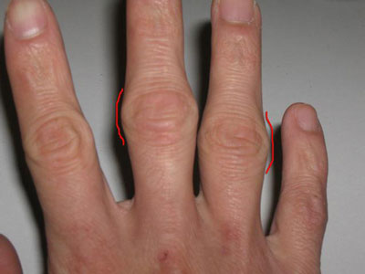Причины появления шишек на пальцах рук
