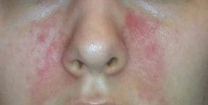 Причины и лечение покраснения вокруг носа