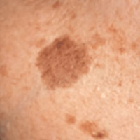 Происхождение и виды коричневых пятен на коже