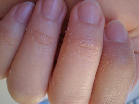 Почему шелушится кожа на руках, особенно вокруг пальцев