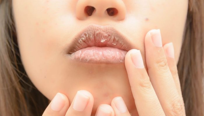 Слезает кожа с губ: причины