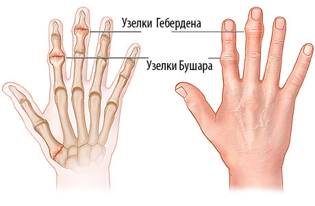 Почему на пальцах появляются небольшие шишки или наросты