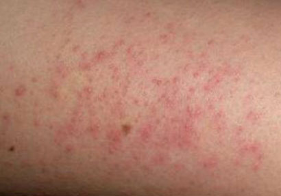 Мелкие красные прыщики на теле у взрослого при аллергии