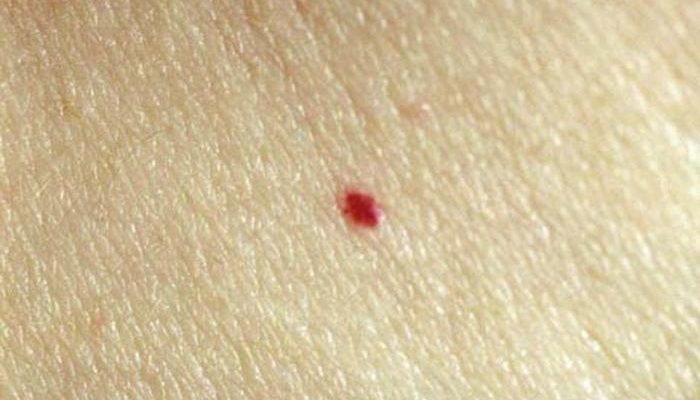 Почему появляются красные точки на теле? Возможные болезни и методы их лечения