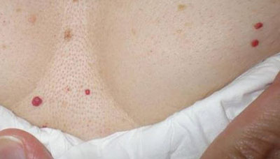 Причины появления красных мелких точек на коже тела