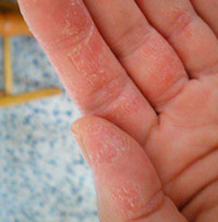 Основные причины шелушения кожи на пальцах рук