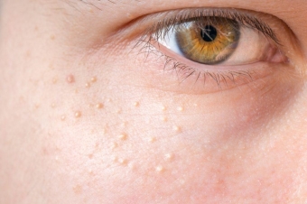 белые угри на лице: причины появления и лечение