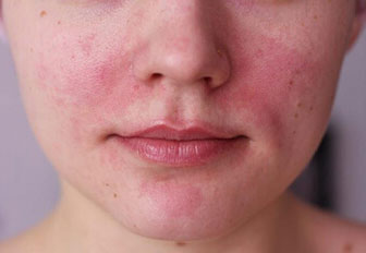Покраснения вокруг носа и шелушение при дерматите