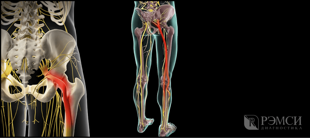 Защемление седалищного нерва: симптомы