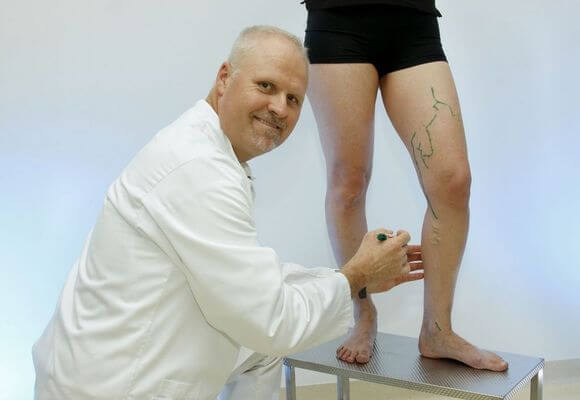 лечение варикоза ног