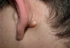 Шарик и уплотнение за ухом – что это и как лечить шишку