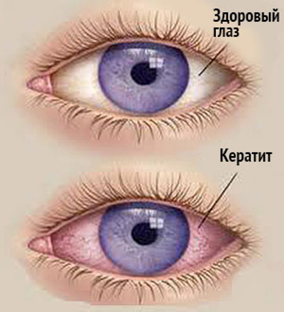 Заболевание глаз - кератит