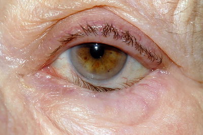 Глазное заболевание - заворот века