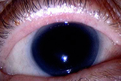Заболевание глаз - аниридия