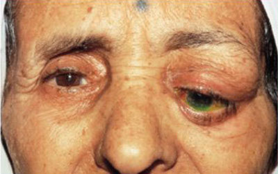 Заболевание глаз - дакриоаденит