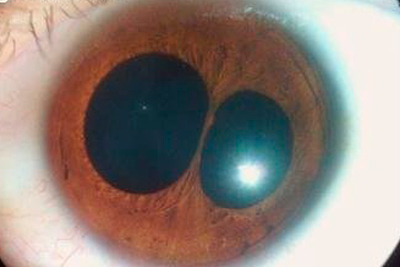 Заболевание глаз - поликория