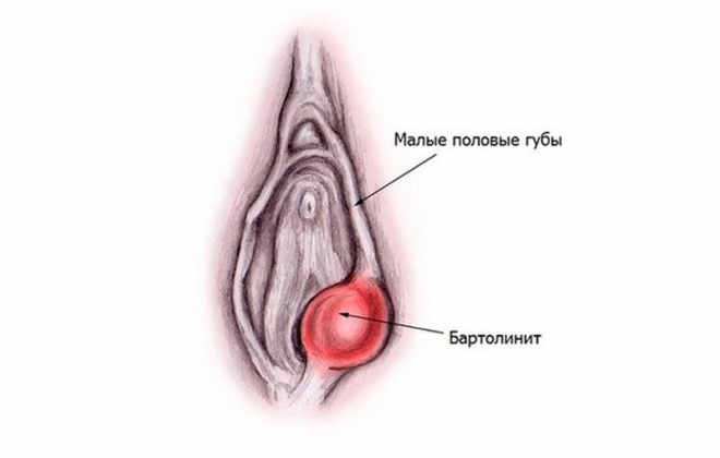 Киста бартолиновой железы