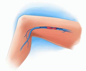Поражение артерий тромбами