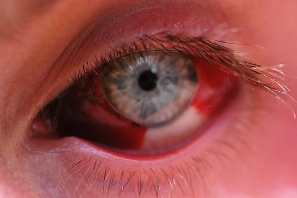 Причины покраснения глаз у взрослых