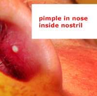 pimple in nose