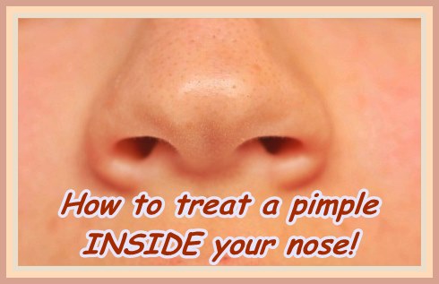 how to treat a pimple inside your nose