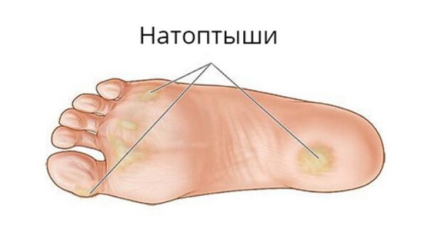 Места на стопе для появления натоптышей