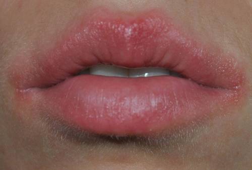 Аллергия на губах