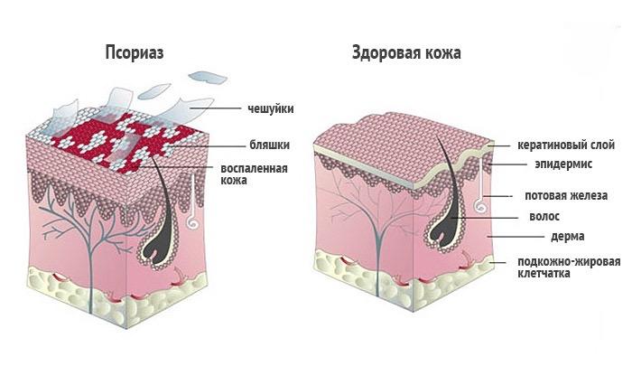 Псориаз