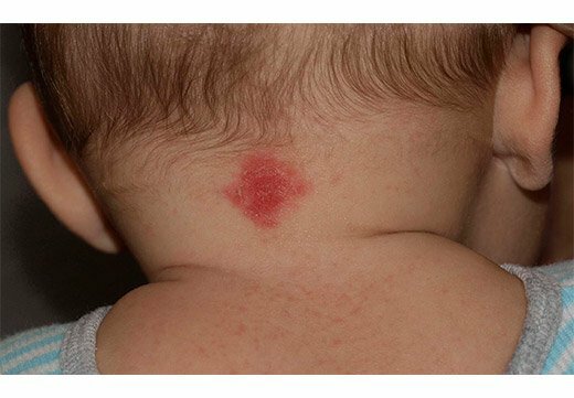красное пятно на шее у ребенка