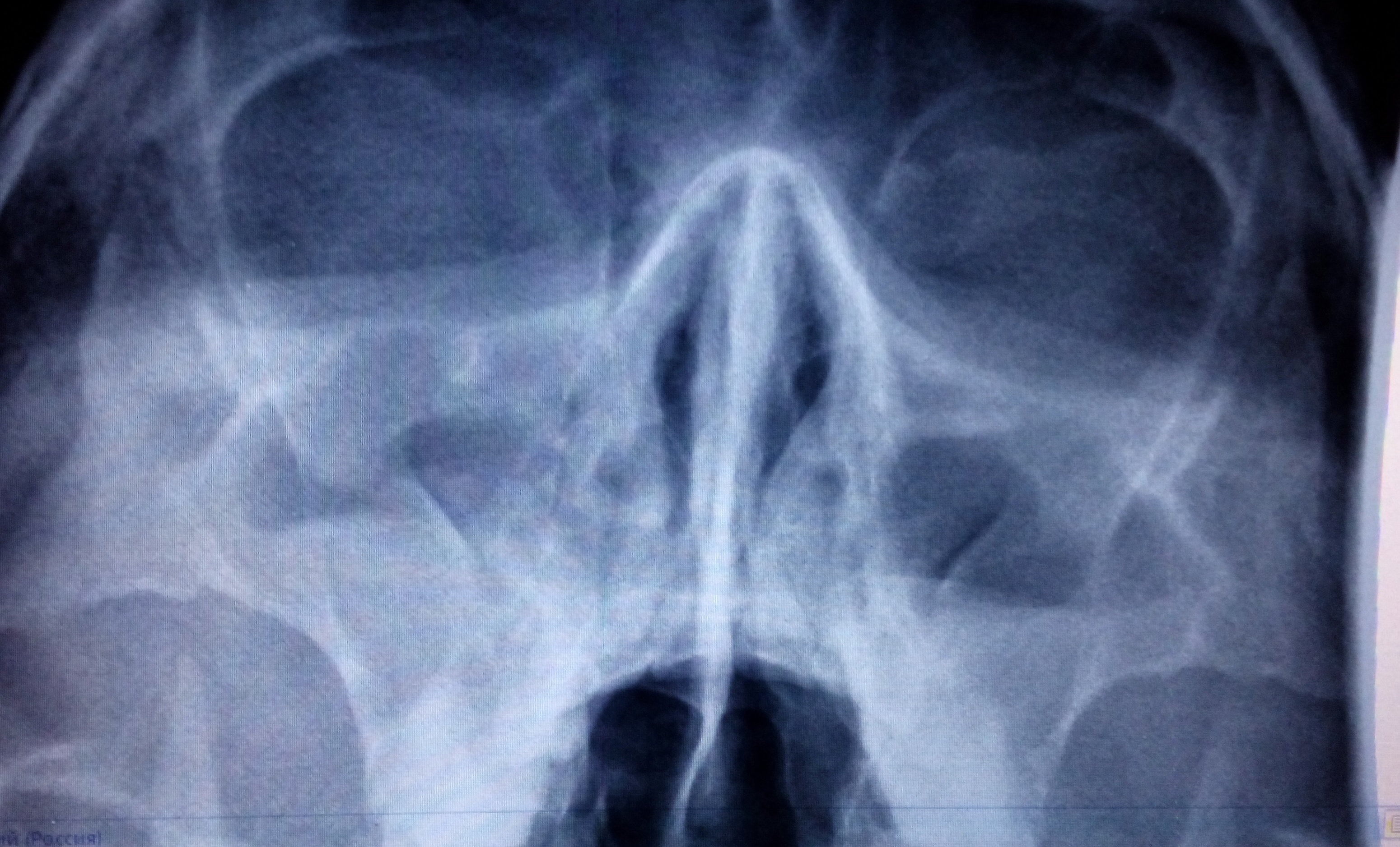 Снимок. Фронтит снимок рентген. Пансинусит на рентгенограмме. Рентген околоносовых пазух гайморит. Рентгенография пазух носа фронтит.