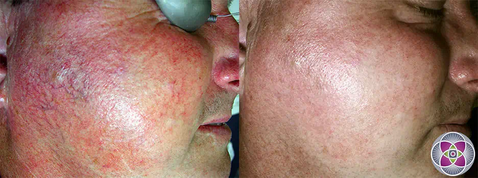 Laser treatments combined with other modalities are by far the best way to get rid of rosacea.