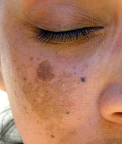 Dark spots on skin caused by Melasma
