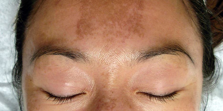 The most common Melasma causes include: sun exposure and hormonal changes caused by pregnancy or birth control